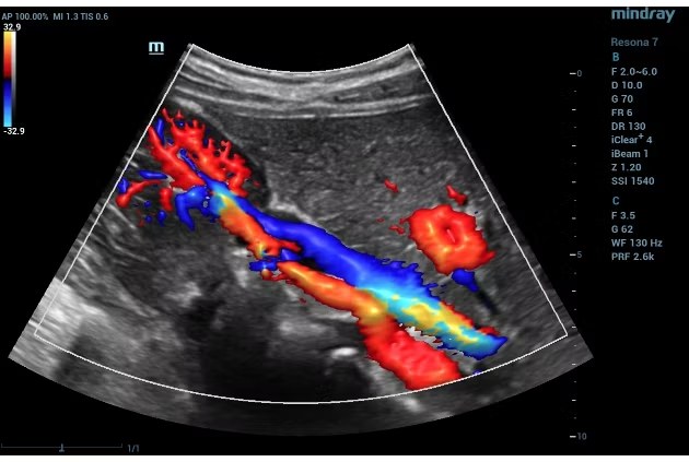 Renkli Doppler Ultrason